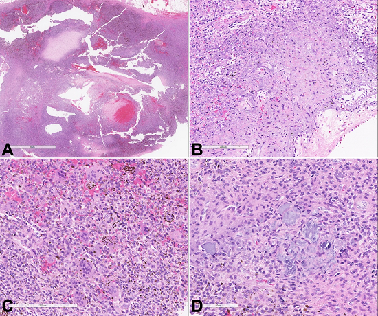 Photomicrography of the tumor with A - Hypercellular and hypocellular areas, hemorrhage and vascular network; B - Bland spindled cells and unusual basophilic matrix a &ldquo;grungy&rdquo; calcification pattern; C - Cellular proliferation of bland spindle cells with scattered osteoblasts and hemosiderin; D - The neoplastic cells produce smudgy calcifications.