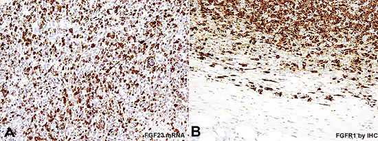 . Photomicrography of the tumor showing in A - Tumor cells are strongly positive for FGF23 mRNA by CISH; B - Strong positivity for FGFR1 by IHC, implying the presence of the FN1-FGFR1 fusion.