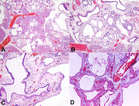 Photomicrography of the pancreatic hamartoma, showing in A, B and C - cysts and ducts lined by cuboidal epithelium, primitive mesenchymal proliferation and exocrine gland formation (H&E, 10X, 20X and 40X respectively); in D - mesenchymal proliferation by Masson&rsquo;s trichrome stain (20X).