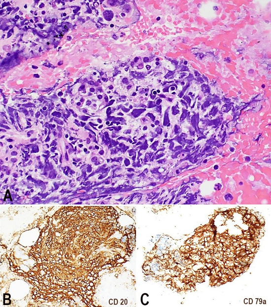 Photomicrography of the cell block. A - Highly atypical large cells intermixed with pancreatic acini (H&E, 20X). Those cells were positive for CD20 and CD79a in B and C, respectively (10X).
