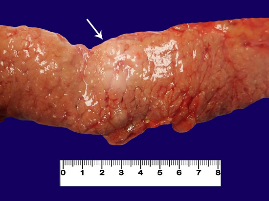 Post-mortem gross image of the pancreatic mass (arrow).