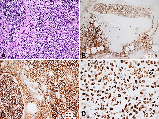 Photomicrography of pancreatic mass section is seen in A (H&E 10x). CD5, CD20 and Ki67(20x) immunohistochemistry stains in B, C and D, respectively, show intravascular infiltration of the lymphoma cells, which were positive for CD20 and CD5 with a high Ki67 proliferation index.
