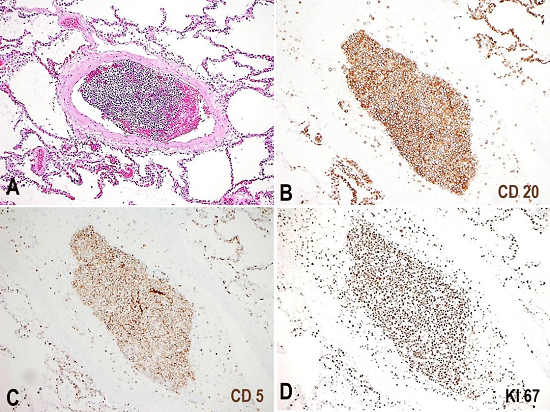 Photomicrography of representative lung section is seen in A (H&E 10x). CD20, CD5 and Ki67 immunohistochemistry stains in B, C and D, respectively, show intravascular infiltration by lymphoma cells positive for CD20 and CD5, with a high Ki67 proliferation index.