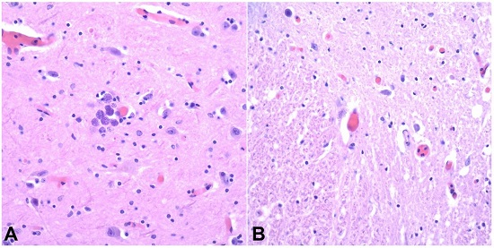 Photomicrographs of the brain showing the T. gondii cysts in the Midbrain (A - H&E, 400X) and the Brainstem (B - H&E, 400X).