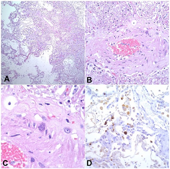 Photomicrographs of the lungs exhibiting necrotizing bronchopneumonia (A - H&E, 100X). T. gondii cysts in Lungs (B-D, B-C - H&E, 400X and 1000X respectively, D -T. gondii stain 400X).