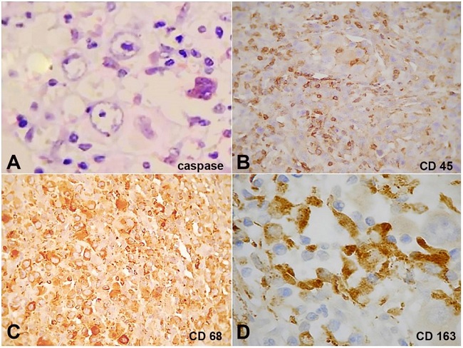 Immunohistochemical markers. A - Caspase 3, focal, 200x; B - CD45, in histological section of skin, 200x; C - CD68, diffuse, 400x; D - CD163, diffuse, 400x.