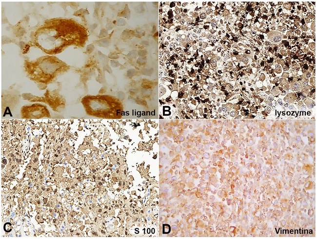 Immunohistochemical markers. A - Fas-ligand, diffuse, 1000x; B - Lysozym, diffuse, 200x; C - S-100, focal, 200x; and D - Vimentin, diffuse, 400x.