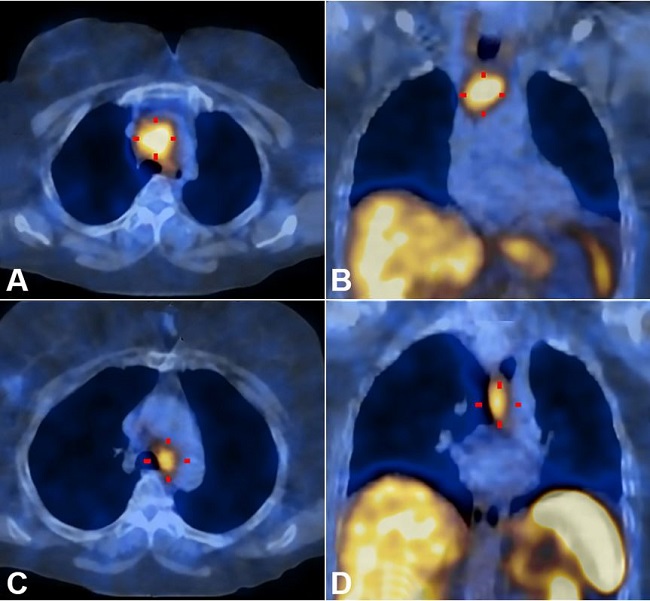 Histologic section of the tumor. A and B show the lymph node totally infiltrated by a solid neoplasm. Note the presence of neoplasia beyond the node’s capsule within the adjacent soft tissue (H&E 40X). The neoplastic cells show an epithelioid phenotype with overlapping features to those of the cytological sample; C, D, E and F show immunoexpression of CK8/18, chromogranin, TTF1 and synaptophysin respectively (400X).