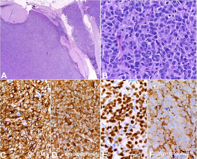 Somatostatin receptor scintigraphy revealed a high uptake in two mediastinal masses, consistent with disease relapse. A and B show axial and coronal planes of mediastinal mass in 3a station respectively; C and D show axial and coronal planes of mediastinal mass in 4L station respectively.