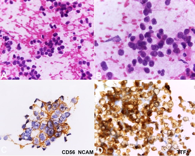 Computed tomography scan showing mediastinal masses enlargement during chemotherapy. A and B show axial planes of mediastinal mass in 3a station before and after oral etoposide respectively; C and D show axial planes of mediastinal mass in 4L station before and after of oral etoposide respectively.