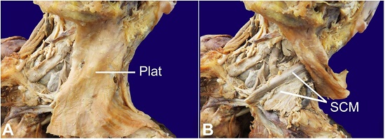 Dissection of the left-sided posterior cervical triangle revealed the presence of a Virchow node obscured entirely by the platysma and clavicular head of the sternocleidomastoid muscle and partly by the superior belly of the omohyoid muscle. A - Superficial dissection revealing the platysma muscle (Plat); B - The sternocleidomastoid muscle (SCM) underlying the reflected platysma.