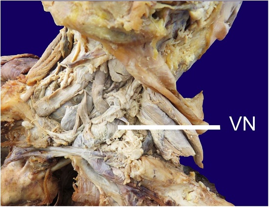 Dissection of the left-sided posterior cervical triangle, after reflection of both the platysma and sternocleidomastoid muscles, revealed a Virchow node (VN) in the region of the lesser supraclavicular fossa.