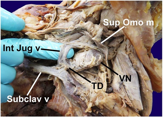 Gross dissection of the left-sided lower anterior cervical region revealing a Virchow node (VN). The node was partially obscured at its superior pole by the superior belly of the omohyoid muscle (Sup Omo m) which has been retracted in this image. The node joined the thoracic duct (TD) which joined together with the internal jugular vein (Int Jug v) to contribute to the subclavian vein (Subclav v). The platysma and sternocleidomastoid muscles are reflected posteriorly and proximal half of the clavicle was resected to reveal the Virchow node and its surrounding vascular anatomy. The long axis of the VN was oriented parallel to the internal jugular vein and the distal thoracic duct.