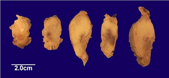 Serial sections of the Virchow node. The cut surfaces are almost entirely replaced by a grossly evident metastatic tumor.