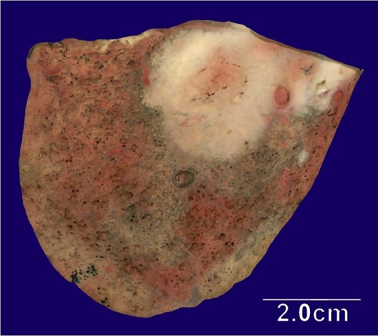 Transverse section of the lower lobe of the left lung showing a 4.2 × 4.0 × 3.5 cm solid, pale, indurated mass that encases the adjacent vasculature and abuts the hilum. The uninvolved parenchyma is tan with dilated air spaces and many areas of environmental pigmentation.