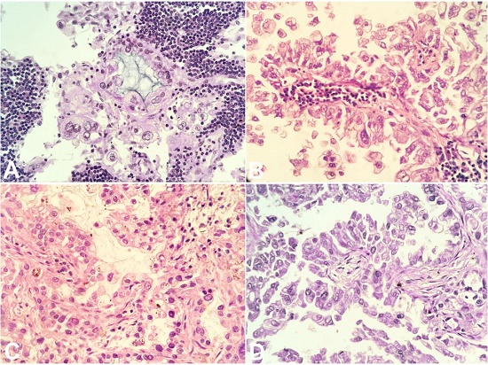 Side-by-side histopathological comparison between the Virchow node and lung masses (Hematoxylin and eosin stain at 400X magnification) A & B - Virchow node sections revealing neoplastic cells embedded within residual lymphoid tissue. The cells have a high nuclear to cytoplasmic ratio and display marked bizarre nuclei with prominent macronucleoli. The neoplastic cells form mixed morphology consisting of glandular (A) and papillary (B) architecture. Intracellular as well as extracellular mucin is readily identified; C & D - Histological sections of the lung mass with morphologic findings that correspond with the characteristics found within the Virchow node, consistent with metastasis from the lung tumor.