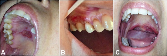 Gross examination of the oral lesions. A - Flat lesion covered with a fibrin pseudo membrane with regular erythematous borders on the hard palate; B - Ulcer on the vestibular and palatal gingiva between the 16 and 17 teeth; C - Ulcer on the left soft palate near the uvula.