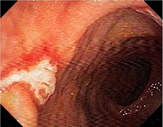 Colonoscopy image depicting area of inflammatory process with mucosal erosion and ulceration in the descending colon.