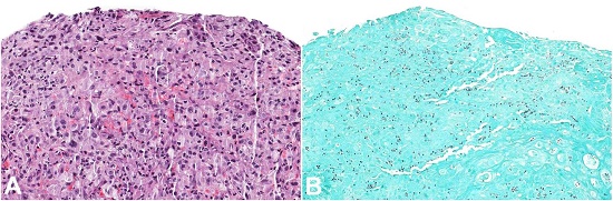 Photomicrograph of the oral biopsy. A - Areas of squamous mucosa with intense histiocytic inflammatory infiltrate associated with rounded fungal structures consistent with Histoplasma spp. (H&E 200X); B - Gomori-Grocott’s staining showing positivity for fungi (H&E 200X).