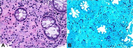 Photomicrograph of the rectal biopsy. A - Areas with intense histiocytic inflammatory infiltrate associated with rounded fungal structures consistent with Histoplasma spp. (H&E 400X); B - Gomori-Grocott staining showing positivity for fungi(400X).