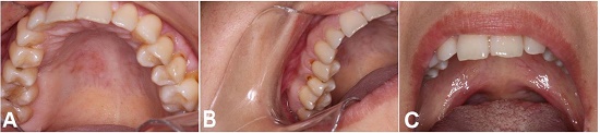 Oral examination after the treatment. Note the complete healing of the lesions on the hard palate (A), gingiva (B), and soft palate (C).