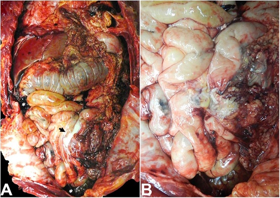 Abdominal cavity, after lifting up the greater omentum, with evidence of intestinal perforation. A - Purulent exudate in small intestinal loops (black arrow) with adhesions, and hemoperitoneum (white asterisks); B - Extensive small bowel edema, purulent exudate, and focal hemorrhage of mesenteric fat.