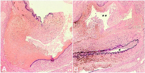 Photomicrographs of the cystic artery. A - Disruption of the elastic lamina of the cystic artery at point of rupture with blood extravasation, (Verhoeff&rsquo;s stain, 200x); B - Dissecting track between the arterial adventitia and media with double lumen formation. True lumen demarcated by the inner elastic lamina (one asterisk). False lumen located between the inner and outer elastic laminae (two asterisks) (Verhoeff&rsquo;s stain, 200x).