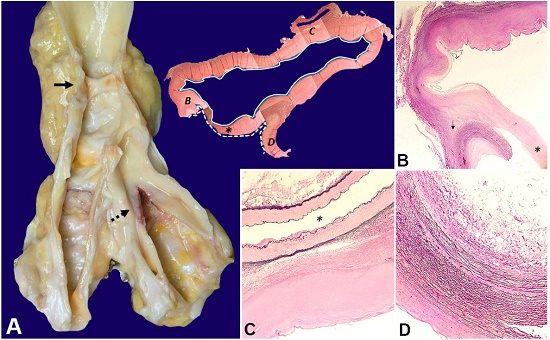 Pathology of the abdominal aorta and iliac arteries. A - Posteriorly opened abdominal aorta with aneurysm and an endothelialized intraluminal band (solid arrow), and dissection and dilation of the iliac arteries with calcifications and hemorrhage (dashed arrow). Composite H&E images of cross-section at the level of endothelialized intraluminal band (asterisk) showing a false lumen or dissecting track (continuous line), and a true lumen (discontinuous line), on the top right; B - Point of cleavage between the adventitia and media (arrow) adjacent to the endothelialized intraluminal band (asterisk) (Verhoeff&rsquo;s stain, 50x); C - False lumen lined by fibrin and fibrous tissue devoid of elastin fibers, which are conserved in the inferior mesenteric artery (asterisk) (Verhoeff&rsquo;s stain, 100x); D - Vascular wall delimiting the true lumen with preservation of elastic fibers of the medial layer and intimal thickening (Verhoeff&rsquo;s stain, 100x).