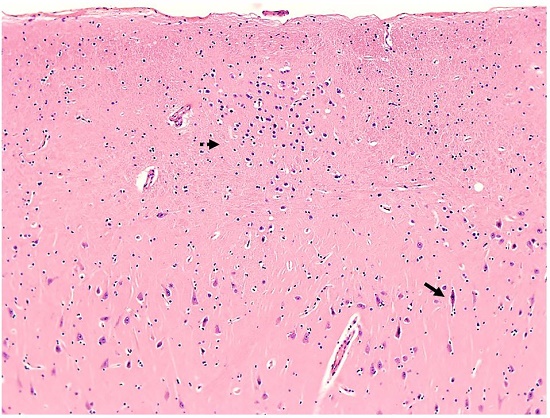 Photomicrograph of the hippocampus. Cornu Ammonis-1 (CA1) showing a focus of neuronal heterotopia in the stratum moleculare (dashed arrow) and red neurons in the hippocampal pyramidal layer (solid arrow) (H&E, 100x).