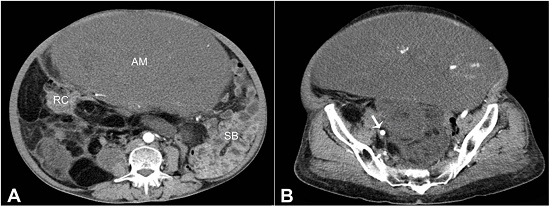 Abdominal computed tomography (CT) (axial plane). A - An abdominopelvic mass (AM) occupying almost whole of the abdominal cavity. The small bowel (SB) is displaced to the left, while the right colon (RC) is abutted against the paracolic gutter; B - Pelvic CT (axial plane) showing right iliac vessels (arrow) adherent to the soft tissue mass.