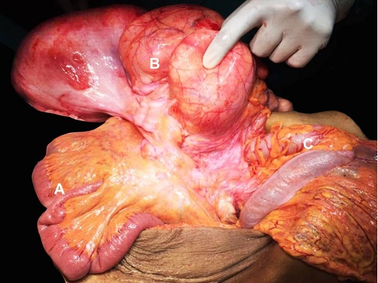 Intraoperatively view of the mass possibly arising from the right colon mesentery or the bowel wall of the right colon. A - Distal ileum; B - Multilobulated soft tissue tumor; C - Transverse colon.