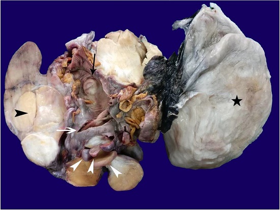 Gross view of the specimen after formalin fixation with multiple fatty to solid gray pedunculated masses some of which appeared to arise from the coalescence of the smaller nodules (black arrowhead). Note the variable sizes of these pedunculated (exophytic masses) (white arrowheads); one mass was endophytic (black arrow) projecting within the cecal lumen. The white arrow highlights the ileocecal valve; the black star highlights the external aspect of the largest exophytic mass.