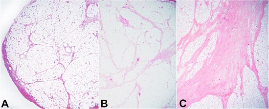 Photomicrographs of the appendices epiploicae of different size from smallest to the largest with gradual increase in the septal thickness and complexity (A-C), with the smallest one showing essentially normal morphology (A) and the larger one displaying thick septa (C).