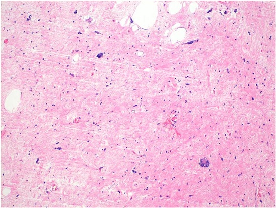 The largest of the appendices showed a sclerosing phenotype with occasional lobules of fat (H&E, 100X). The hyperchromatic atypical stromal cells are evident.