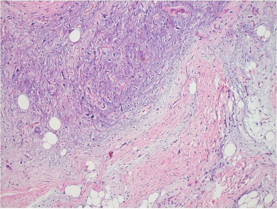 The largest mass showed extensive myxoid stroma (H&E, 200X).