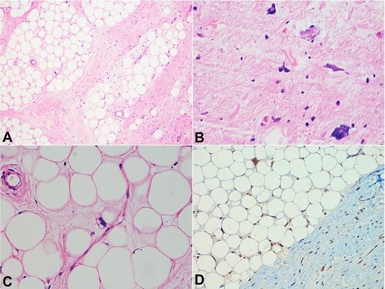 Photomicrographs of the nodular mass. A and B - Thick septa separating the lobules of adipocytes. Note the septa with spindle-shaped singly scattered atypical stromal cells with hyperchromatic nuclei (H&E, 40X and 400X, respectively). C - Multivacuolated lipoblast (H&E, 400X). D - MDM2 immunohistochemistry showing strong nuclear positivity in the stromal cells as well as in the adipocytes (100X).