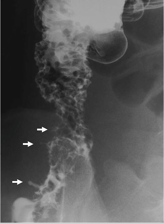 Double-contrast barium enema of the colon showing inflammation of the ascending colon and the cecum. The bowel is narrowed at the lower portion of the ascending colon. Cobblestone appearance is seen in the upper portion of the ascending colon. Fissurings are indicated by arrows.