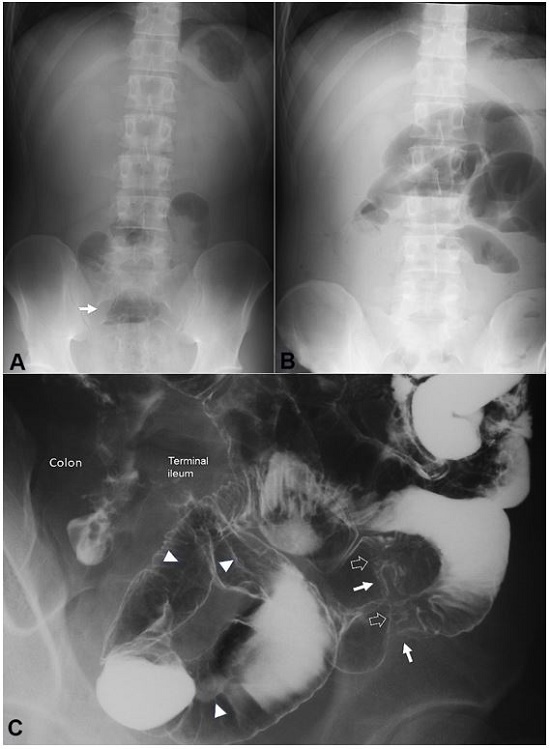 Plain abdominal radiographs on admission (A) and 13 days after the first infusion of infliximab (B). Solitary air-fluid level is indicated by an arrow (A). Multiple air-fluid levels are seen (B); C- Picture of the enteroclysis. Two stenotic portions are observed in the distal part of the ileum (white arrows). At the sites of stenosis, white soft shadows are seen (hollowed arrows) indicating active ulcers. Pre-stenotic dilatation is not observed. Longitudinal ulcers are observed (arrowheads).