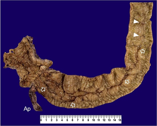 Gross examination of the resected specimen of case 1. Two round ulcers at the proximal site (arrowheads) and a longitudinal ulcer of 30 cm (arrows) are seen in the terminal ileum. Cobblestone appearance is seen in the ascending colon. The appendix (Ap) is swollen.
