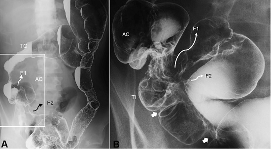 Double-contrast barium enema study. Entire picture of the colon (A) and enlarged picture of the ileocolic portion (B). A - Shortening of the right colon is seen. Diffuse coarse mucosa from the sigmoid colon to the distal part of the descending colon is observed. B - Two stenotic sites in the terminal ileum are indicated by white arrows. There are two entero-enteric fistulas indicated by F. TC, transverse colon; AC, ascending colon; TI, terminal ileum; F, fistula.