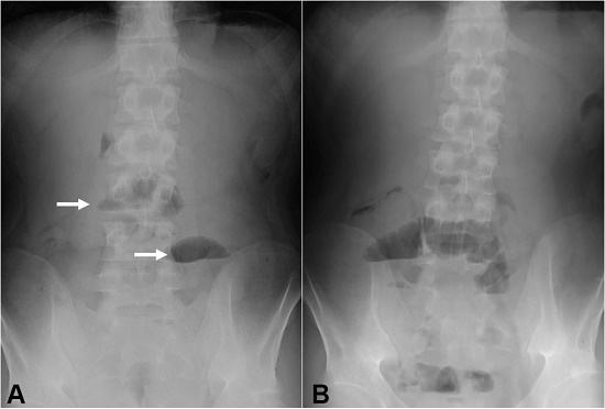 Plain abdominal radiographs on the 11th day after the first infusion of infliximab (A) and the day following resumption of meals after the 3rd infliximab infusion (B). Air-fluid levels are indicated by arrows (A).
