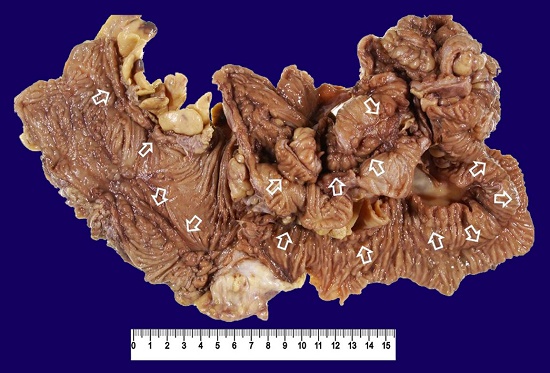 Gross examination of the resected specimen of the case 2. The terminal ileum is fixed to the ascending colon by adhesion through fistulas. They were removed en bloc. Arrows indicate longitudinal ulcers (scar).