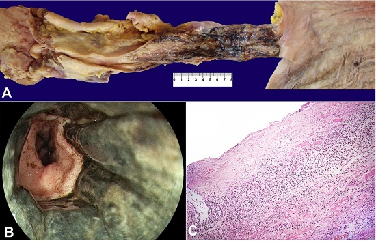 A - A picture composition of the gross aspect of esophagus and adjacent organs. Note the dark appearance of esophageal mucosa and the sharp limit at the gastroesophageal junction. B - Endoscopic view of the distal esophagus. Note the darkened mucosa in every circumference of the organ. C - Microscopic aspect of the esophagus at autopsy showing superficial necrosis of the mucosa and neutrophilic inflammation (H&E 100x). Image courtesy Anatomic Pathology Service - Hospital Universitário - USP.