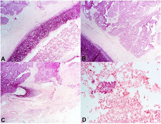 Photomicrography of the tumor. A, B and C - Infiltration of the trachea and bronchi by the malignant cells (H&E, 250X); D - A nest of tumor cells within the lung parenchyma (H&E, 250X).