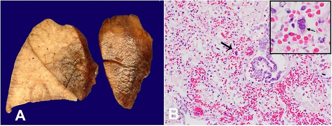 A - Macroscopic view of the lung showing hemorrhagic lobes; B - Microphotograph of the lung showing HSV-infected cell in the lung and multinucleated cell (arrow) with margination of chromatin and molding- Viral nuclear inclusion (H&E, 40 X). Inset shows the detail of the multinucleate cell (60X).