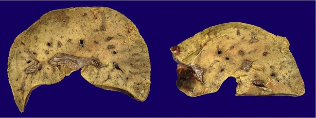 Macroscopic view of the liver- showing hemorrhage in the portal region.