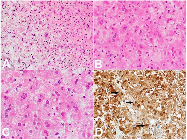 Photomicrograph of the liver showing in A, B and C - HSV infected hepatocytes showing multinucleation, margination of chromatin and molding and hepatocytes with HSV Nuclear viral inclusions with nuclear chromatin pushed against nuclear envelope and those with clear halo around (Cowdry type A/wine red nuclear inclusions) (H&E, 40X, 40X, 60 X respectively); D - Immunostain for HSV1/2 showing nuclear staining (40X) - arrows reflect viral intranuclear stain.