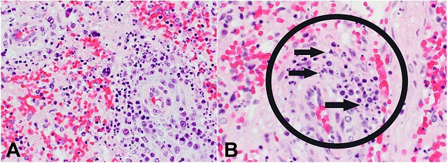 Photomicrograph of spleen showing in A - karyorrhexis and perivascular cell fragments (40X H&E); B - in detail with arrows.