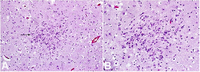 Photomicrograph of the CNS showing in A - thalamus with microglial nodule (arrow) (H&E, 10X); B - detail of the microglial nodule (H&E, 20X).
