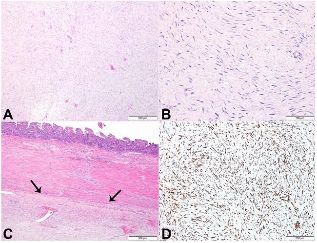 Photomicrograph of the retroperitoneal tumor. A - A sparse proliferation of elongated, slender, spindle-shaped cells of uniform appearance, set in a collagenous stroma (H&E); B - Cells with lack of hyperchromasia or atypia and with small, pale-staining nuclei. These cells are usually arranged in sweeping bundles (H&E); C - Lesion within the enteric wall (arrows) (H&E); D - Histochemistry showing strong expression of vimentin.